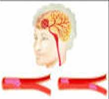 Coronarylsioncrbrale - HIPERnatural.COM