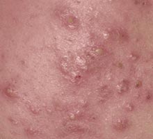 ACNE - HIPERnatural.COM