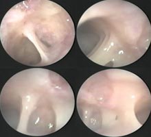ADHSIONUTERINAS - HIPERnatural.COM