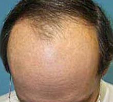 Alopcie - HIPERnatural.COM