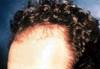 Alopeciaidiopathique - HIPERnatural.COM