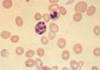 L'anmiepernicieuse(carenceenvitamineB12) - HIPERnatural.COM
