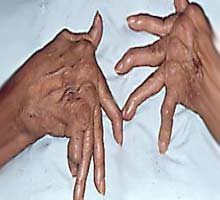 Polyarthriterhumatode - HIPERnatural.COM