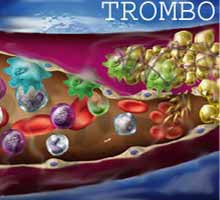 Athrothrombose - HIPERnatural.COM