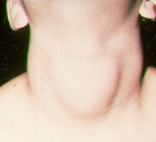 Goitre - HIPERnatural.COM