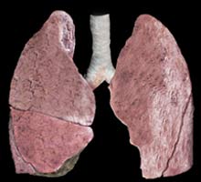 Bronchioliteoblitrante - HIPERnatural.COM