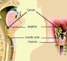 CANCERPharynx - HIPERnatural.COM