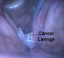 Cancerdularynx - HIPERnatural.COM