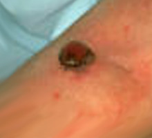 CANCERDELAPEAU - HIPERnatural.COM