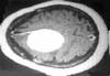 CANCERdusystmenerveuxcentral(cerveauetmoellepinire) - HIPERnatural.COM