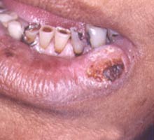 Cancerdelabouche - HIPERnatural.COM