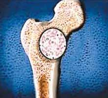 CANCEROSEO - HIPERnatural.COM