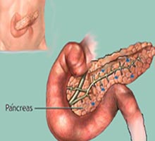 Cancerdupancras - HIPERnatural.COM