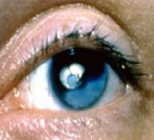 CATARACT - HIPERnatural.COM