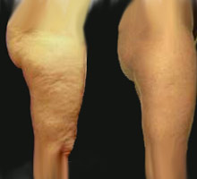Cellulite - HIPERnatural.COM