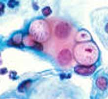 CHLAMYDIA - HIPERnatural.COM