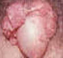 Condylomatosis - HIPERnatural.COM
