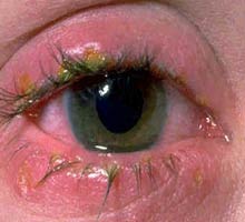 Conjonctivite - HIPERnatural.COM