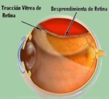 Retinal - HIPERnatural.COM