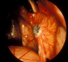 ENDOMETRIOSE - HIPERnatural.COM