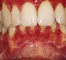 Lesmaladiesparodontales - HIPERnatural.COM