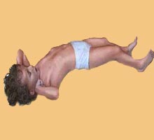EPILEPSY - HIPERnatural.COM
