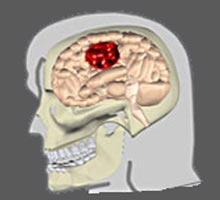 vnementvasculairecrbral - HIPERnatural.COM