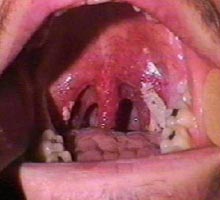 Pharyngite - HIPERnatural.COM