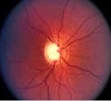 GLAUCOME - HIPERnatural.COM