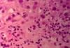 ViralHepatitis - HIPERnatural.COM