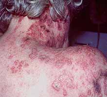 HERPES - HIPERnatural.COM