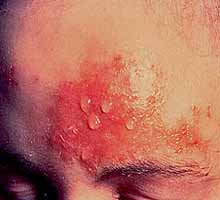 HerpeszosterOFTLMICO - HIPERnatural.COM