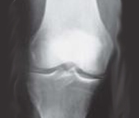 HIPERCALCEMIA - HIPERnatural.COM