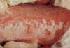 Leucoplasiebnigne - HIPERnatural.COM