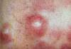 LYMPHOMA - HIPERnatural.COM