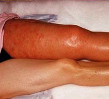 Lupusrythmateux - HIPERnatural.COM