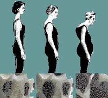 OSTEOPOROSE - HIPERnatural.COM