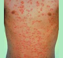 PSORIASIS - HIPERnatural.COM