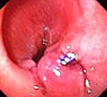 Lerefluxgastro-oesophagien - HIPERnatural.COM