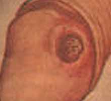 SYPHILIS - HIPERnatural.COM