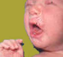 Lasyphiliscongnitale - HIPERnatural.COM