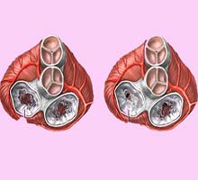 TROUBLESvalvecardiaque - HIPERnatural.COM