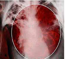 TUBERCULOSE - HIPERnatural.COM