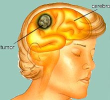 Cancerducerveau - HIPERnatural.COM