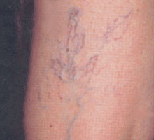 Varices - HIPERnatural.COM